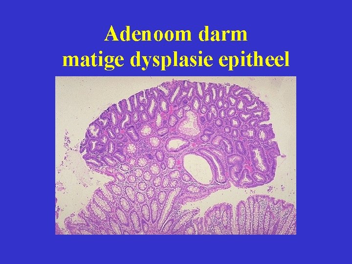 Adenoom darm matige dysplasie epitheel 