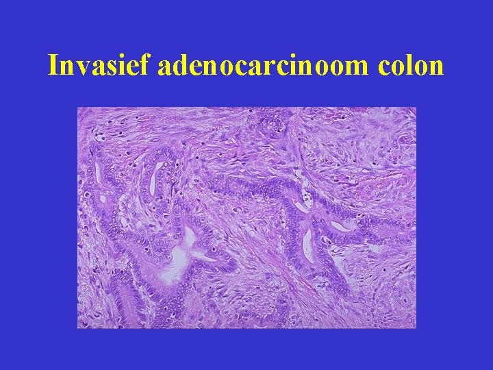 Invasief adenocarcinoom colon 