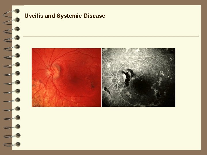 Uveitis and Systemic Disease Uveitis and Systemic Disease