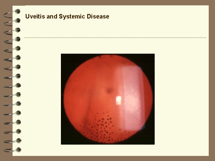 Uveitis and Systemic Disease Uveitis and Systemic Disease