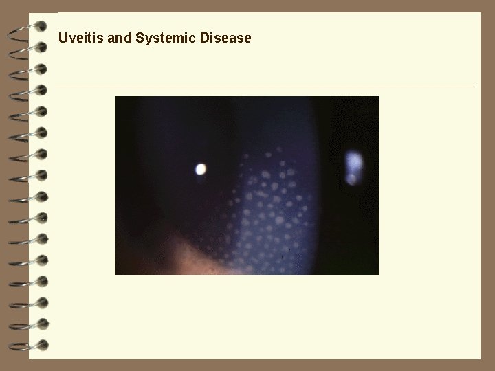 Uveitis and Systemic Disease Uveitis and Systemic Disease