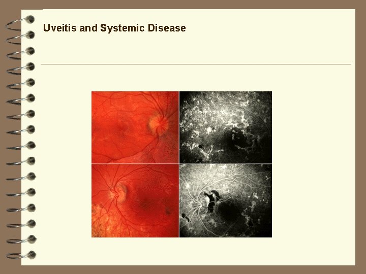 Uveitis and Systemic Disease Uveitis and Systemic Disease