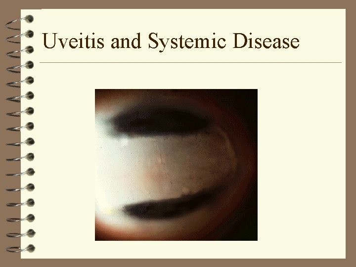 Uveitis and Systemic Disease Uveitis and Systemic Disease
