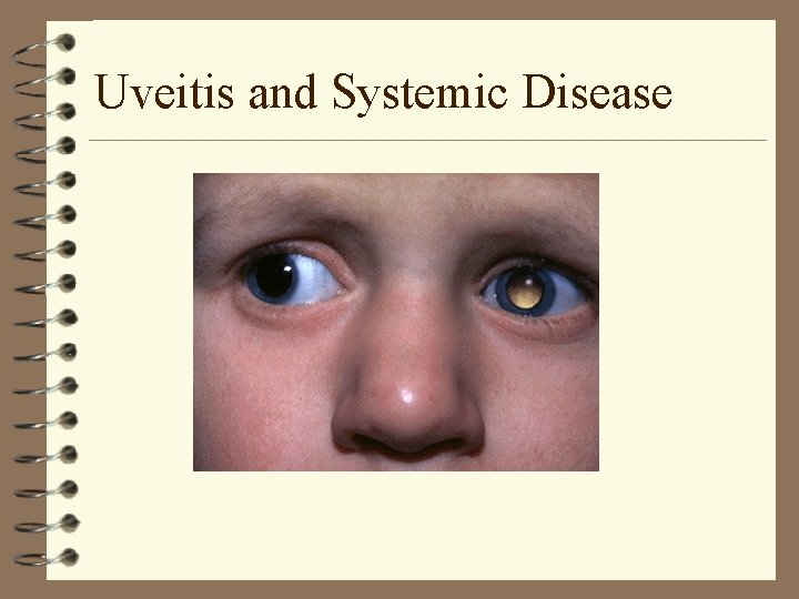 Uveitis and Systemic Disease Uveitis and Systemic Disease