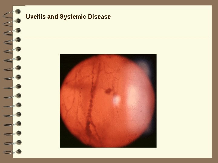 Uveitis and Systemic Disease Uveitis and Systemic Disease