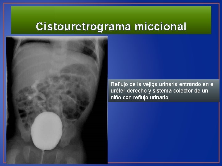 Cistouretrograma miccional Reflujo de la vejiga urinaria entrando en el uréter derecho y sistema