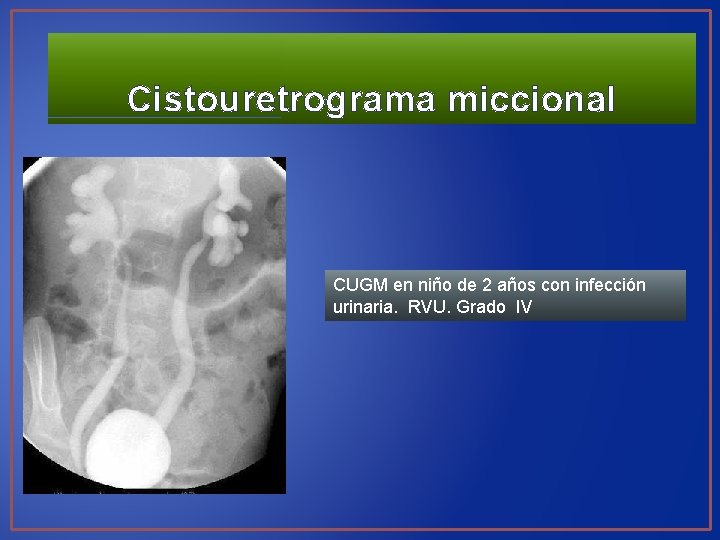 Cistouretrograma miccional CUGM en niño de 2 años con infección urinaria. RVU. Grado IV