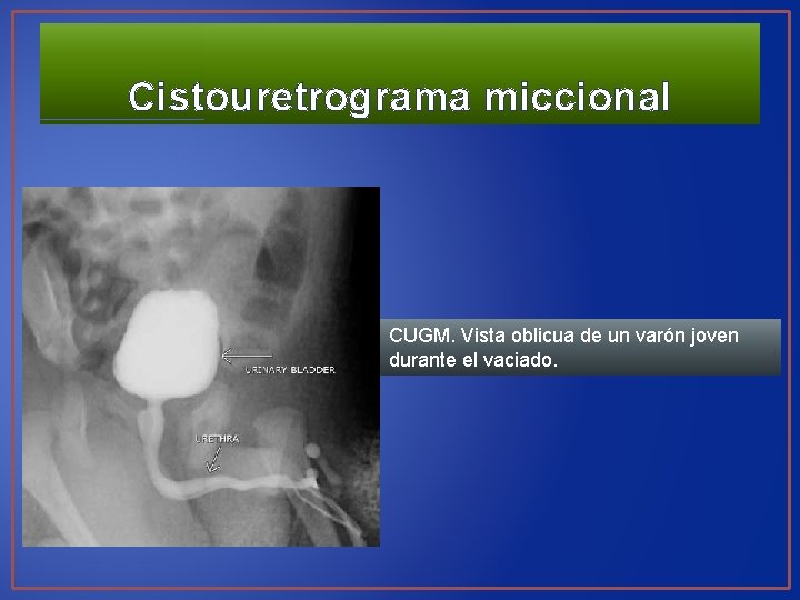 Cistouretrograma miccional CUGM. Vista oblicua de un varón joven durante el vaciado. 