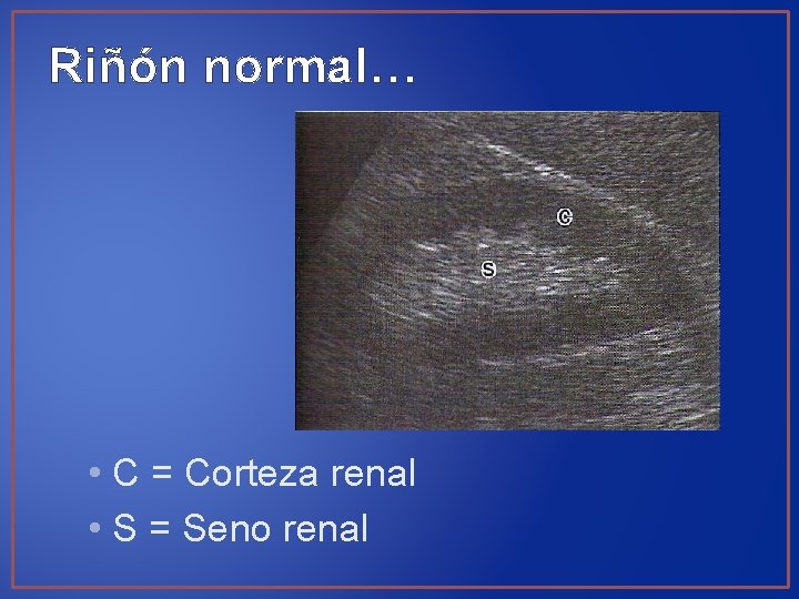Riñón normal… • C = Corteza renal • S = Seno renal 