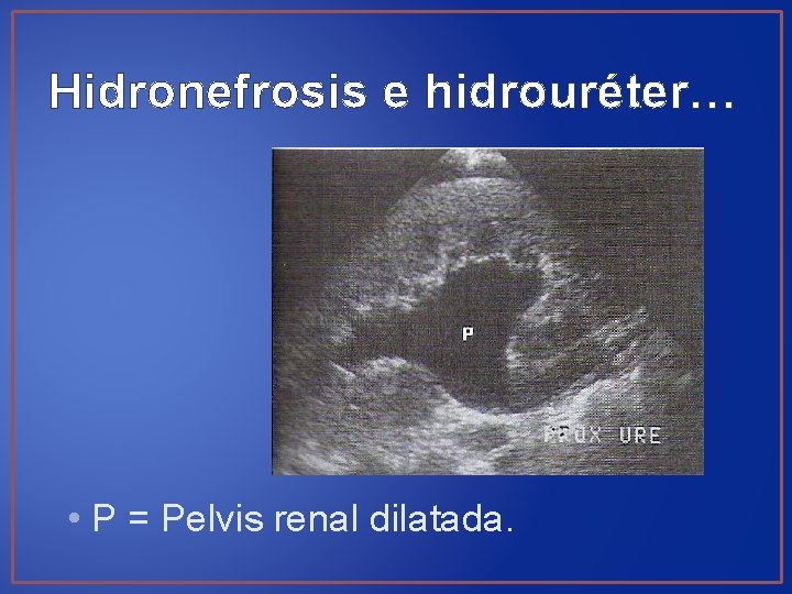 Hidronefrosis e hidrouréter… • P = Pelvis renal dilatada. 