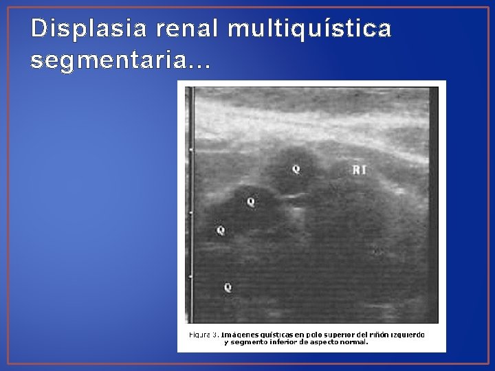Displasia renal multiquística segmentaria… 