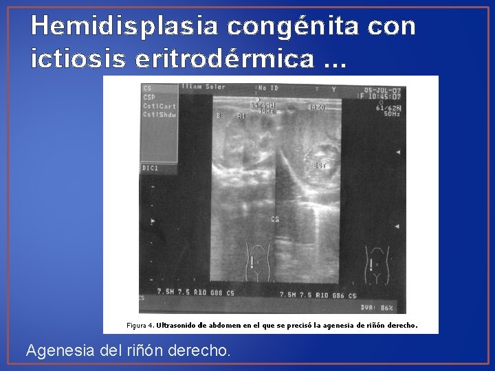 Hemidisplasia congénita con ictiosis eritrodérmica. . . Agenesia del riñón derecho. 