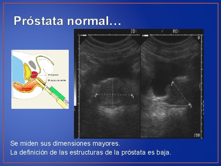 Próstata normal… Se miden sus dimensiones mayores. La definición de las estructuras de la