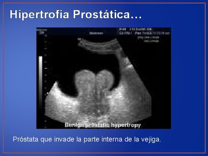 Hipertrofia Prostática… Próstata que invade la parte interna de la vejiga. 