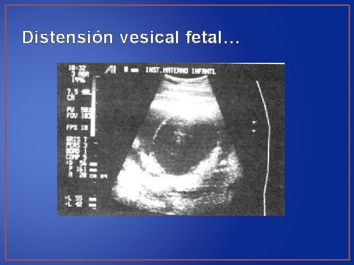Distensión vesical fetal… 