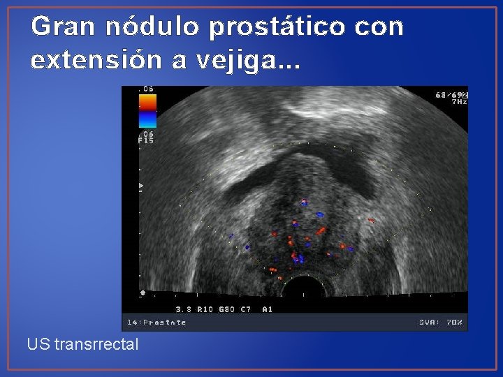 Gran nódulo prostático con extensión a vejiga. . . US transrrectal 