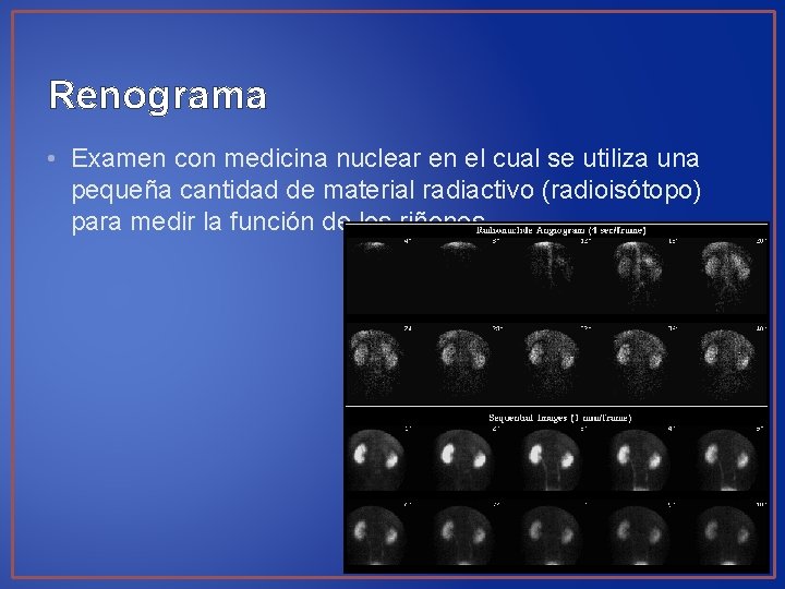Renograma • Examen con medicina nuclear en el cual se utiliza una pequeña cantidad