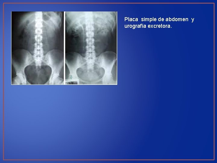 Placa simple de abdomen y urografía excretora. 
