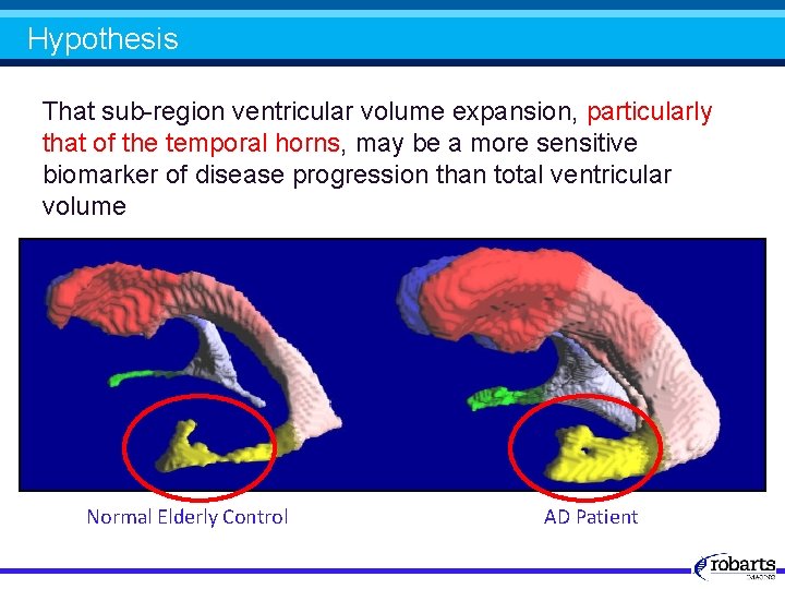 Hypothesis That sub-region ventricular volume expansion, particularly that of the temporal horns, may be