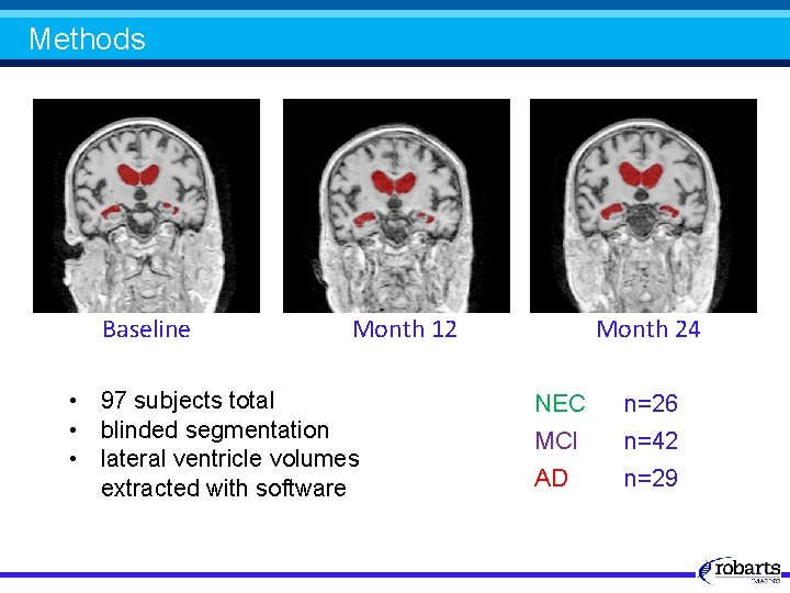 Methods Baseline Month 12 • 97 subjects total • blinded segmentation • lateral ventricle