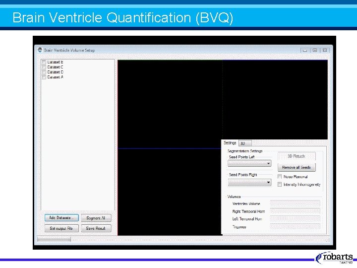 Brain Ventricle Quantification (BVQ) 