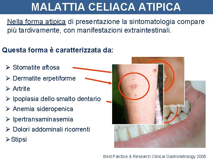 MALATTIA CELIACA ATIPICA Nella forma atipica di presentazione la sintomatologia compare più tardivamente, con