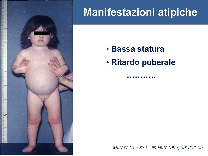 Manifestazioni atipiche • Bassa statura • Ritardo puberale ………. . Murray JA. Am J