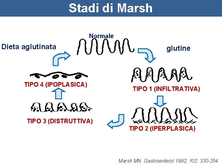 Stadi di Marsh Normale Dieta aglutinata TIPO 4 (IPOPLASICA) glutine TIPO 1 (INFILTRATIVA) TIPO