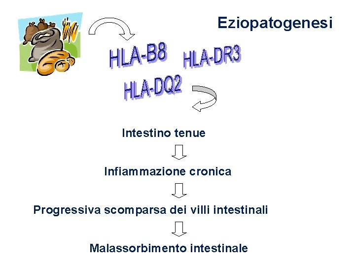 Eziopatogenesi Intestino tenue Infiammazione cronica Progressiva scomparsa dei villi intestinali Malassorbimento intestinale 