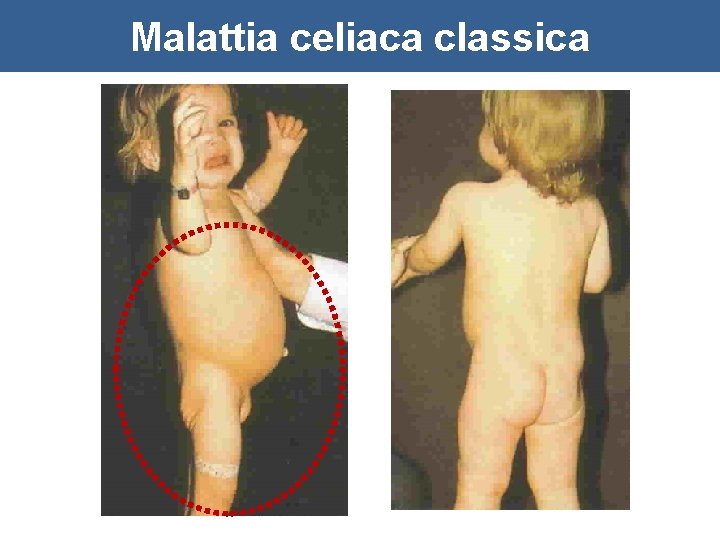 Malattia celiaca classica 