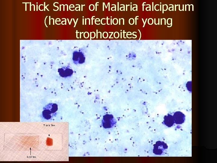Thick Smear of Malaria falciparum (heavy infection of young trophozoites) My Picturesfalciparum_thickfilm_1. jpg 