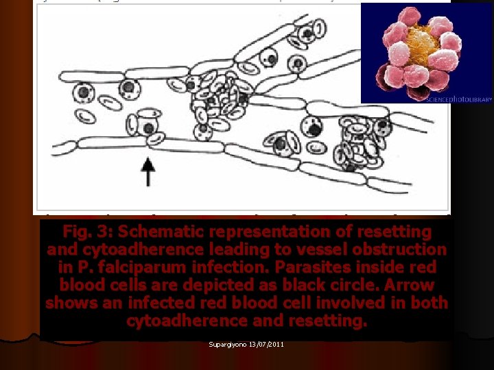 Fig. 3: Schematic representation of resetting and cytoadherence leading to vessel obstruction in P.