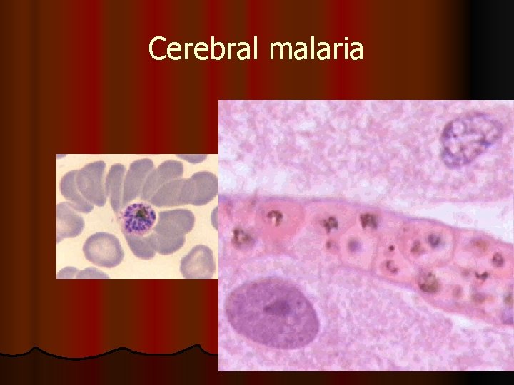 Cerebral malaria 