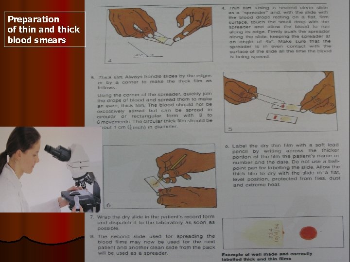 Preparation of thin and thick blood smears 