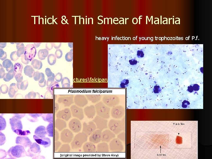 Thick & Thin Smear of Malaria heavy infection of young trophozoites of P. f.
