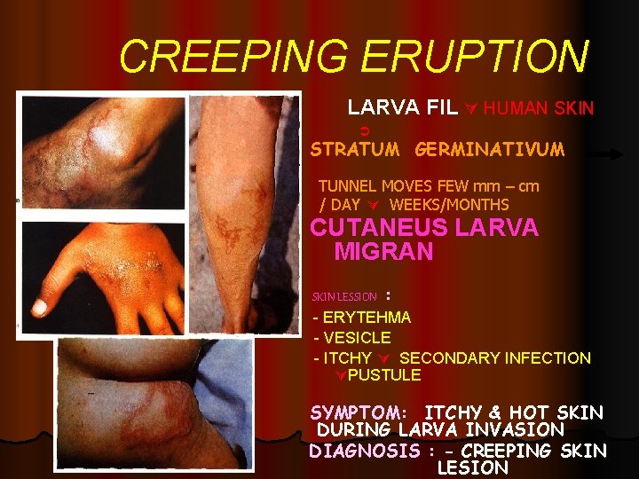 CREEPING ERUPTION LARVA FIL HUMAN SKIN STRATUM GERMINATIVUM TUNNEL MOVES FEW mm – cm