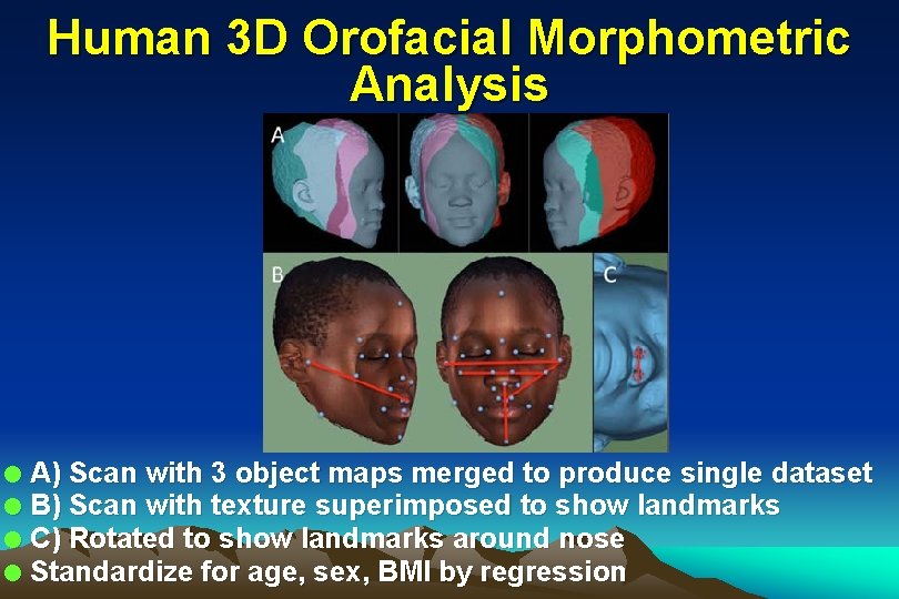 Human 3 D Orofacial Morphometric Analysis l l A) Scan with 3 object maps