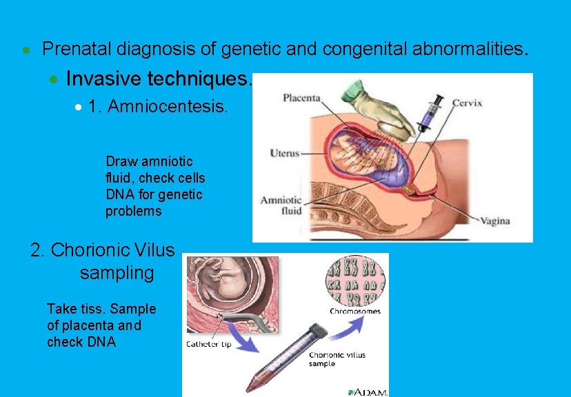 · Prenatal diagnosis of genetic and congenital abnormalities. · Invasive techniques. · 1. Amniocentesis.