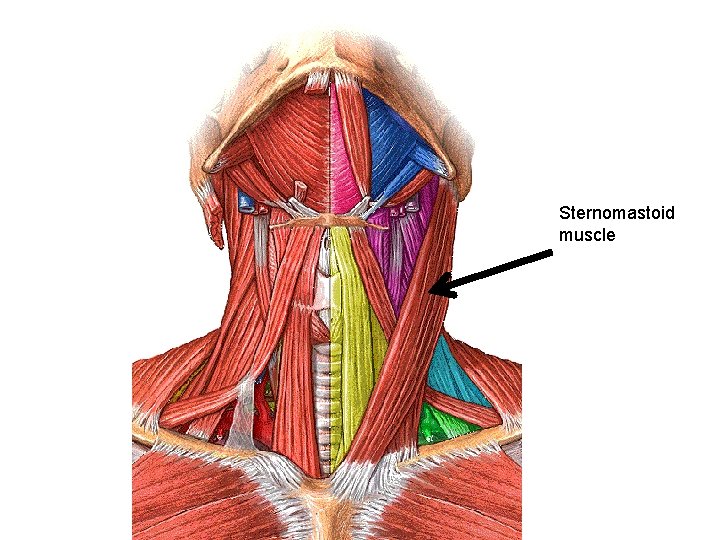 Sternomastoid muscle 