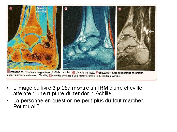  • L’image du livre 3 p 257 montre un IRM d’une cheville atteinte