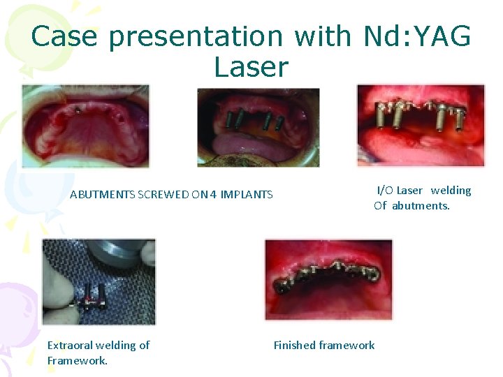 Case presentation with Nd: YAG Laser ABUTMENTS SCREWED ON 4 IMPLANTS Extraoral welding of