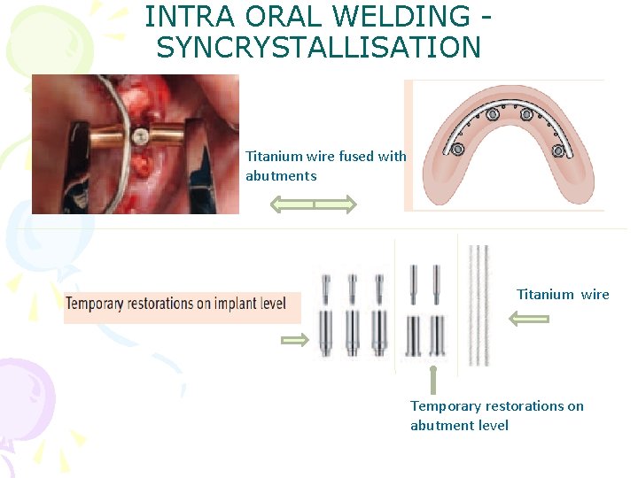 INTRA ORAL WELDING SYNCRYSTALLISATION Titanium wire fused with abutments Titanium wire Temporary restorations on