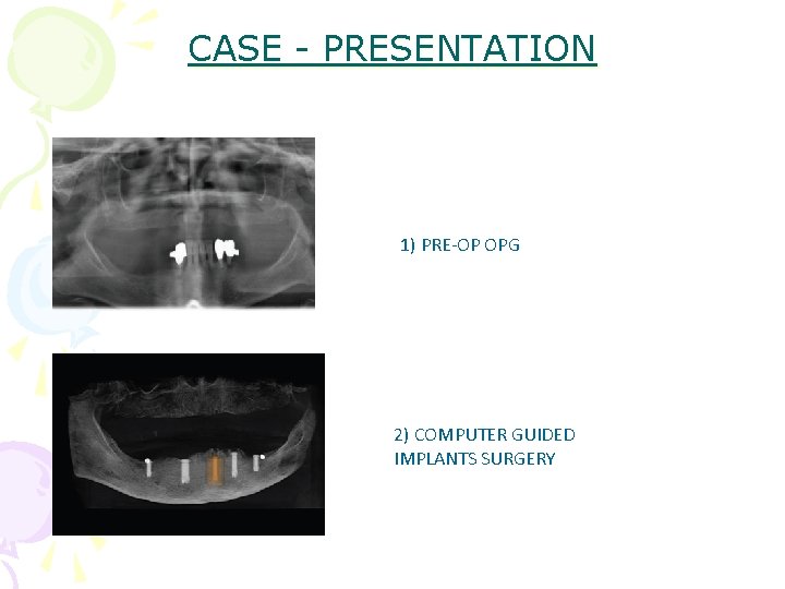 CASE - PRESENTATION 1) PRE-OP OPG 2) COMPUTER GUIDED IMPLANTS SURGERY 