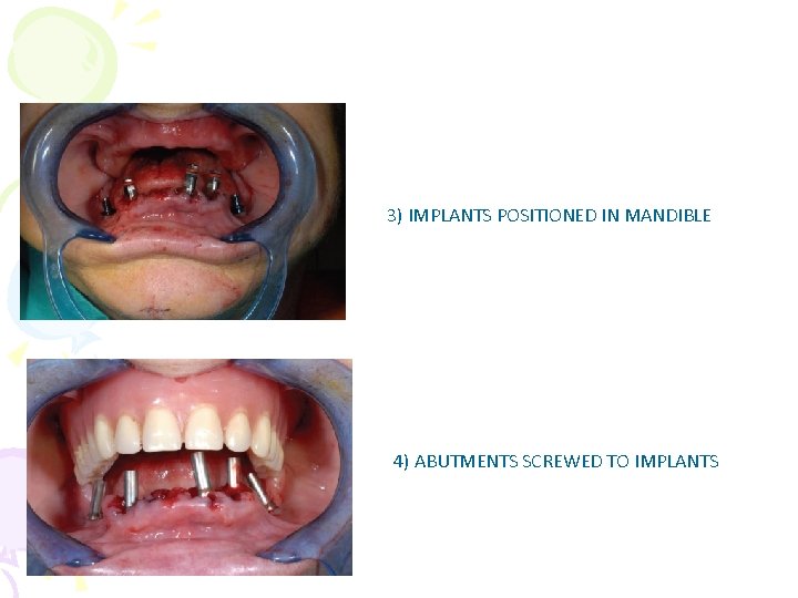 3) IMPLANTS POSITIONED IN MANDIBLE 4) ABUTMENTS SCREWED TO IMPLANTS 