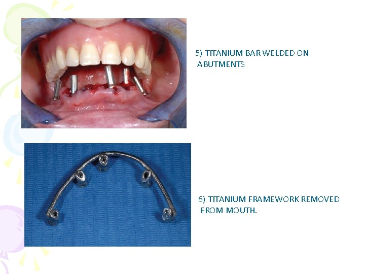 5) TITANIUM BAR WELDED ON ABUTMENTS 6) TITANIUM FRAMEWORK REMOVED FROM MOUTH. 