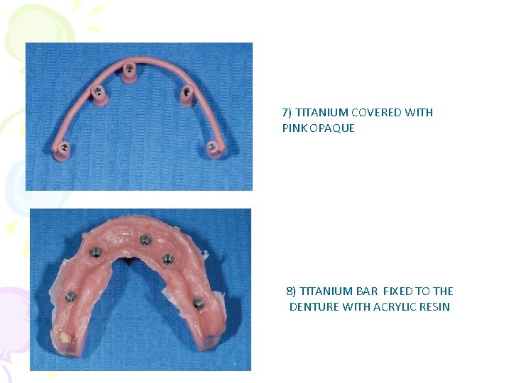 7) TITANIUM COVERED WITH PINK OPAQUE 8) TITANIUM BAR FIXED TO THE DENTURE WITH