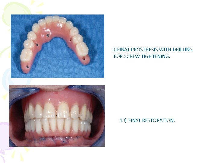 9)FINAL PROSTHESIS WITH DRILLING FOR SCREW TIGHTENING. 10) FINAL RESTORATION. 