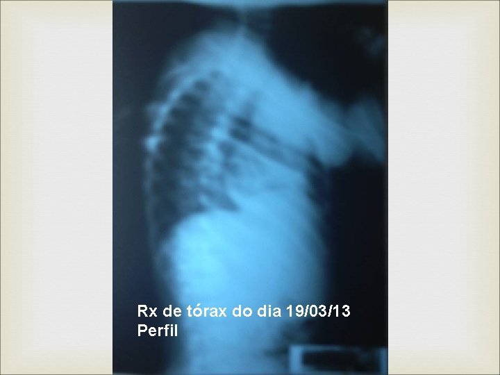 Rx de tórax do dia 19/03/13 Perfil 