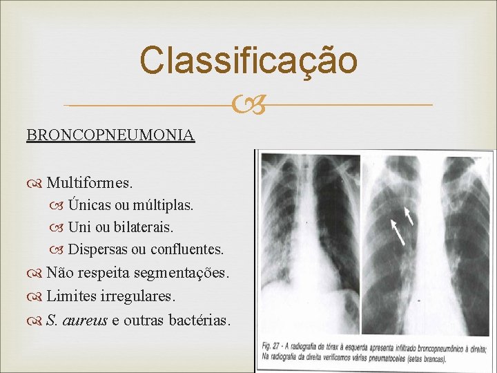 Classificação BRONCOPNEUMONIA Multiformes. Únicas ou múltiplas. Uni ou bilaterais. Dispersas ou confluentes. Não respeita