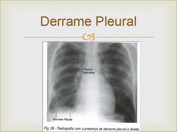 Derrame Pleural 